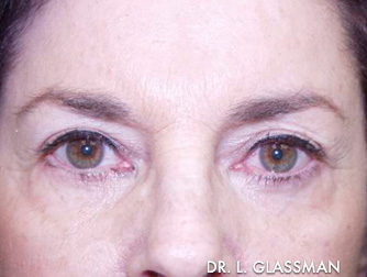 Blepharoplasty Before and After Results