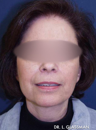 Facelift Results New York