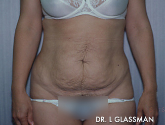 Abdominoplasty