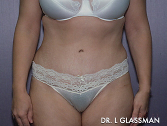 Abdominoplasty