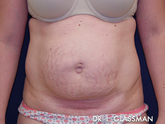 Abdominoplasty