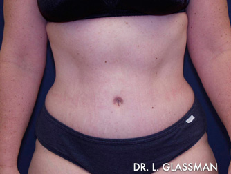 Abdominoplasty