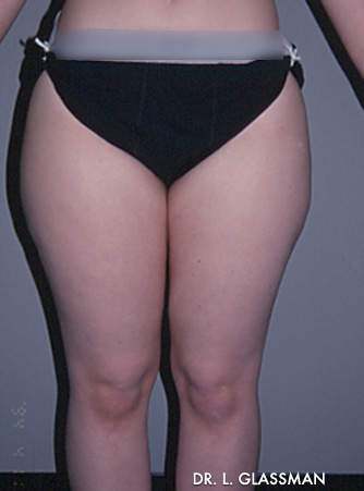 Liposuction Case 3040 Before Photo Liposuction