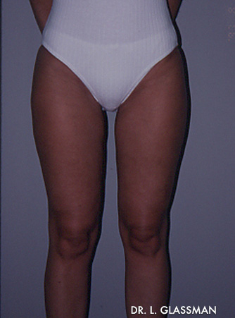 Liposuction Case 3044 After Photo Liposuction