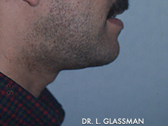 Liposuction Case 3048 After Photo Liposuction