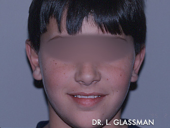 Otoplasty