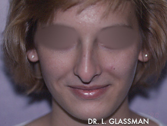 Rhinoplasty Case 3116 Before Photo Rhinoplasty