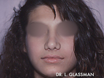 Rhinoplasty Case 3124 After Photo Rhinoplasty