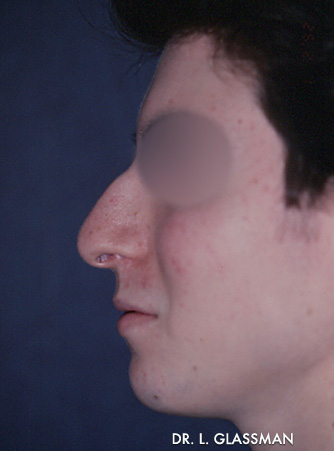 Rhinoplasty Case 3132 Before Photo Rhinoplasty