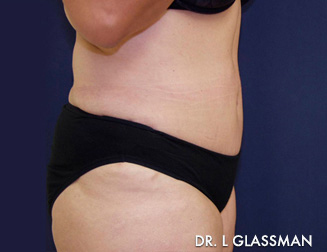 Abdominoplasty Case 3020 After Photo Abdominoplasty