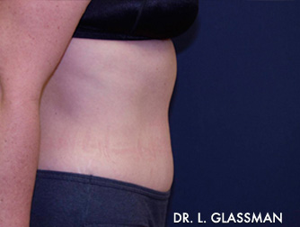 Abdominoplasty