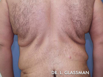 Bariatric Surgery Case 3034 Before Photo Bariatric Surgery
