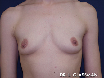 Breast Augmentation Before and After New York