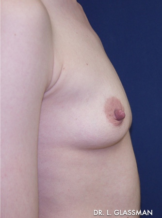 Breast Augmentation Case 3052 Before Photo Breast Augmentation