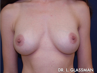 Breast Augmentation Before and After Results New York