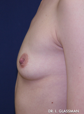 Breast Augmentation Case 3052 Before Photo Breast Augmentation
