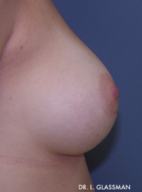 Breast Augmentation