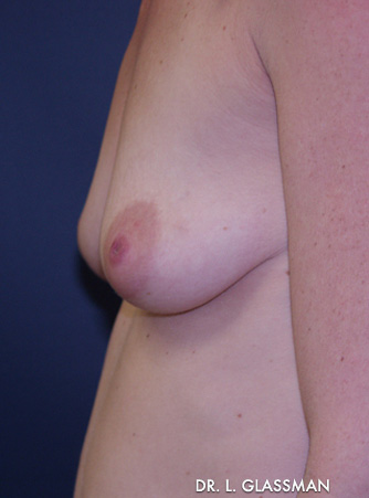 Breast Augmentation Case 3056 Before Photo Breast Augmentation