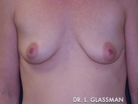 Breast Augmentation