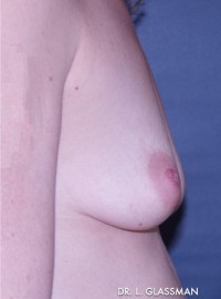 Breast Augmentation