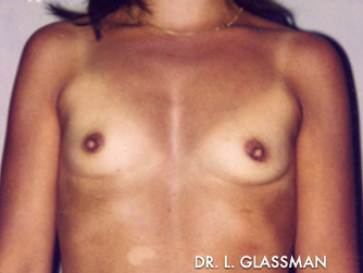 Breast Augmentation Case 3060 Before Photo Breast Augmentation