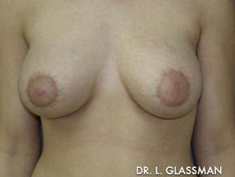 Breast Augmentation Case 3064 After Photo Breast Augmentation