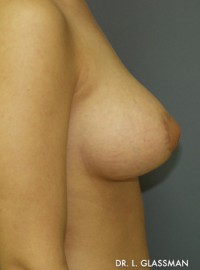 Breast Augmentation