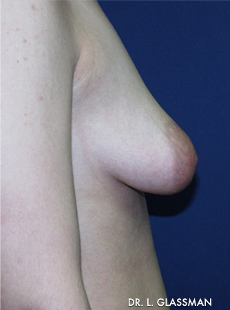 Breast Augmentation Case 3064 Before Photo Breast Augmentation