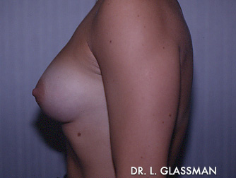 Breast Augmentation Case 3068 After Photo Breast Augmentation