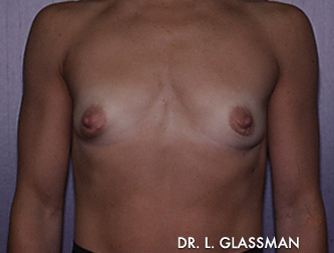 Breast Augmentation Case 3068 Before Photo Breast Augmentation