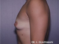 Breast Augmentation