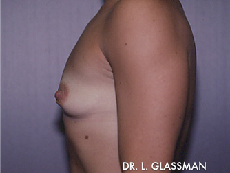 Breast Augmentation Case 3068 Before Photo Breast Augmentation