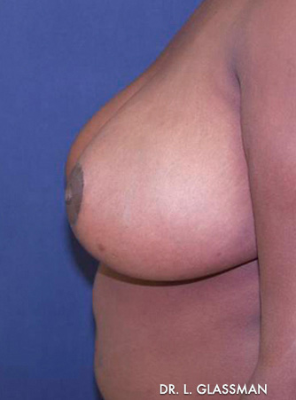 Breast Reduction Case 3072 After Photo Breast Reduction