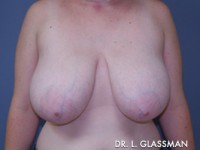 Breast Reduction