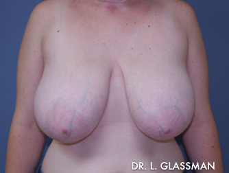 Breast Reduction Case 3076 Before Photo Breast Reduction