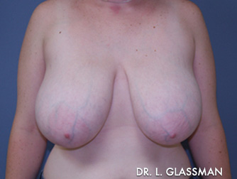 Breast Reduction