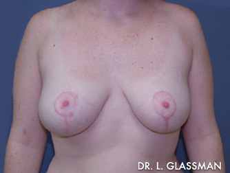 Breast Reduction Case 3076 After Photo Breast Reduction