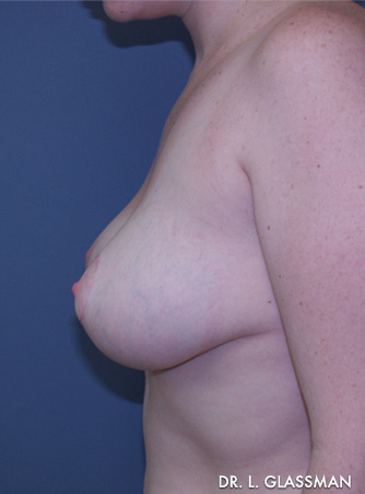 Breast Reduction Case 3076 After Photo Breast Reduction