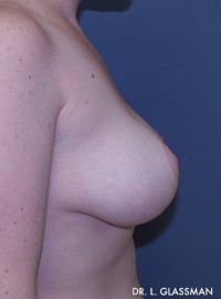 Breast Reduction