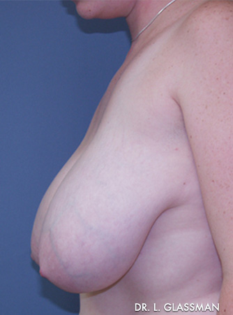 Breast Reduction Case 3076 Before Photo Breast Reduction