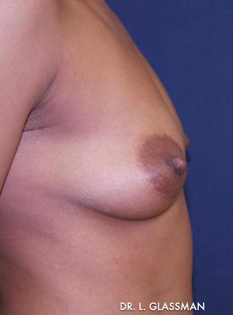 Breast Reconstruction Case 3080 Before Photo Breast Reconstruction