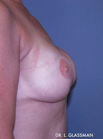 Breast Reconstruction Case 3084 After Photo Breast Reconstruction