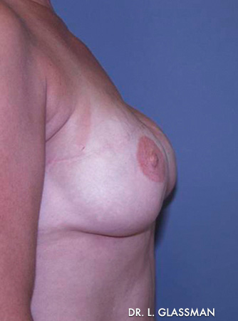 Breast Reconstruction