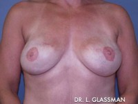 Breast Reconstruction