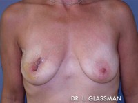 Breast Reconstruction