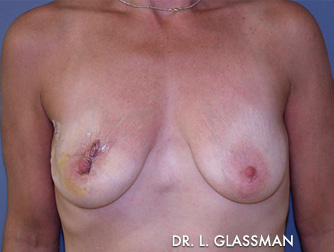 Breast Reconstruction Case 3084 Before Photo Breast Reconstruction