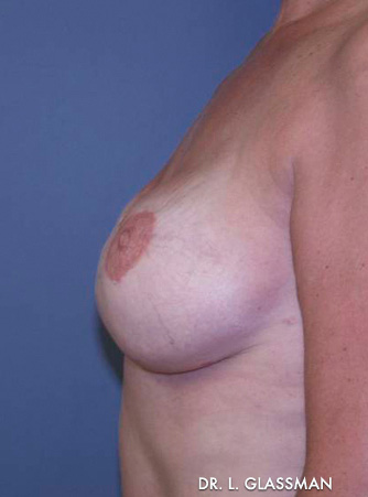 Breast Reconstruction Case 3084 After Photo Breast Reconstruction