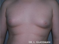 Gynecomastia (Male Breast Reduction)