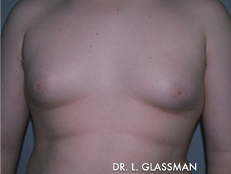 Gynecomastia (Male Breast Reduction) Case 3088 Before Photo Gynecomastia (Male Breast Reduction)