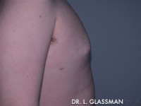 Gynecomastia (Male Breast Reduction)